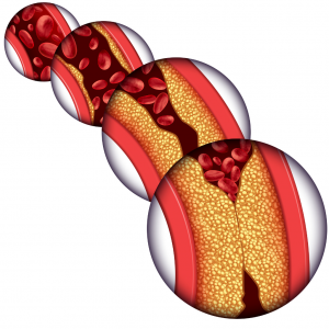 cholesterol particle